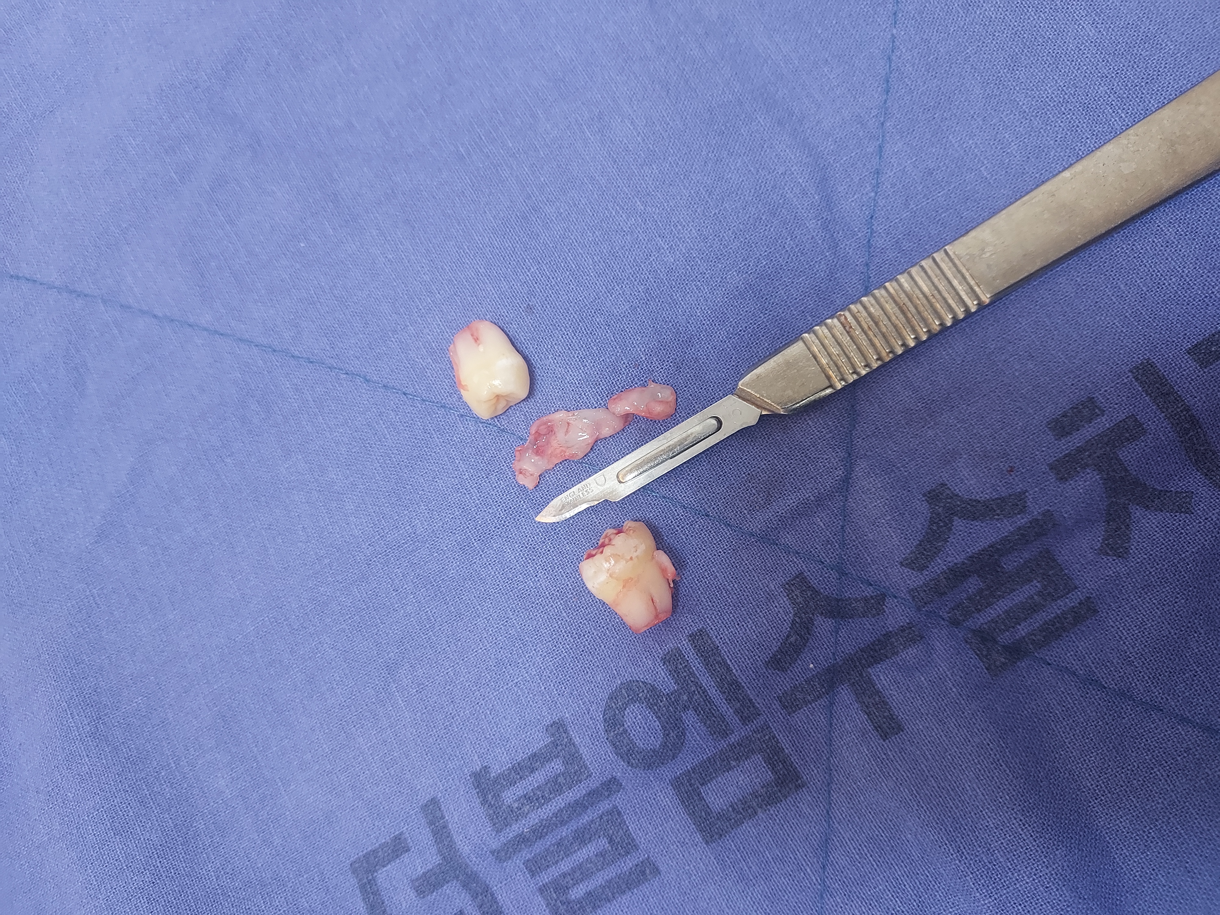 서구 더블엠구강악안면외과에서 사랑니와 종양 수술 후기