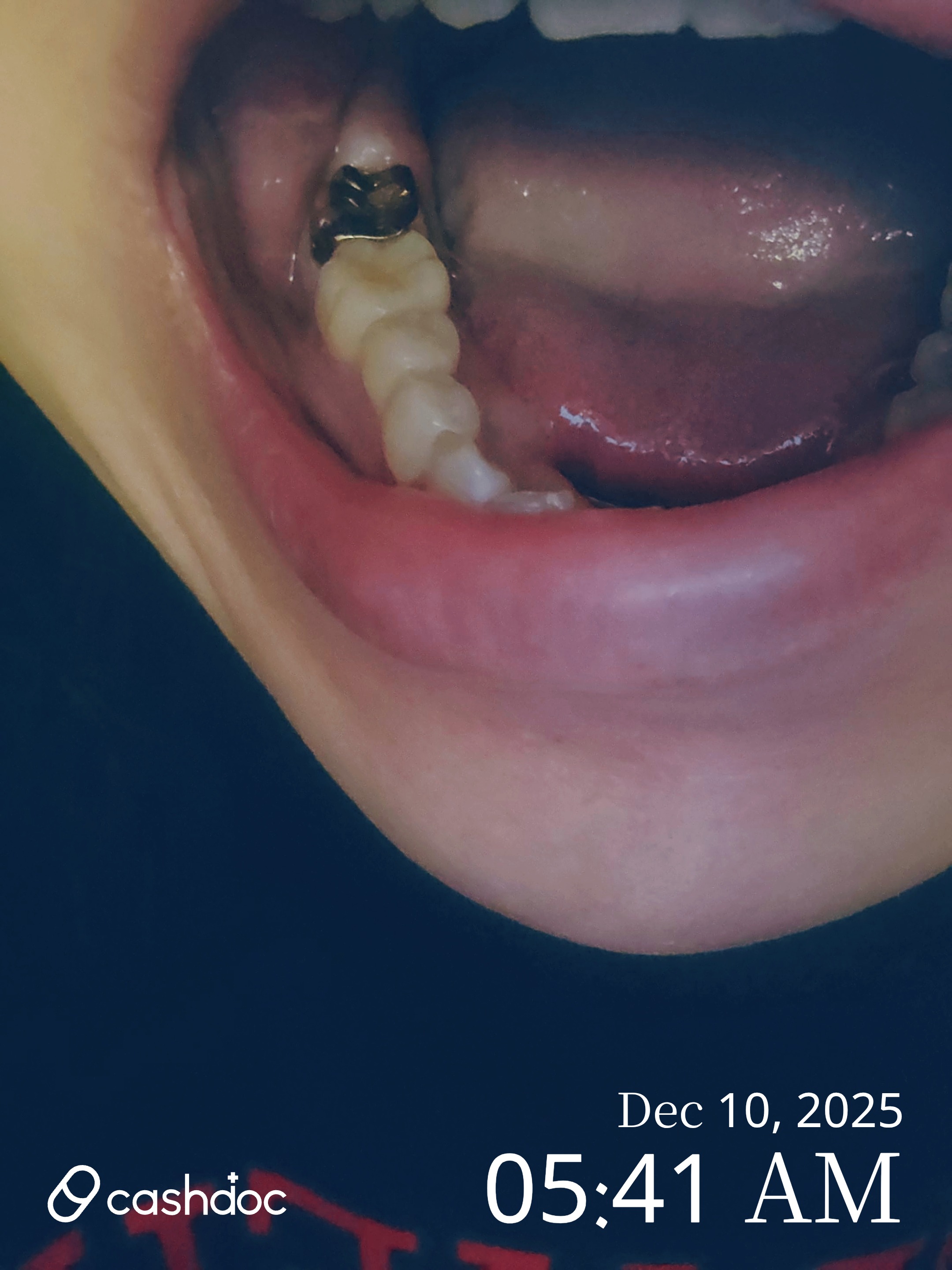 군포시 김이서울치과 크라운 치료, 믿고 맡길 만해요