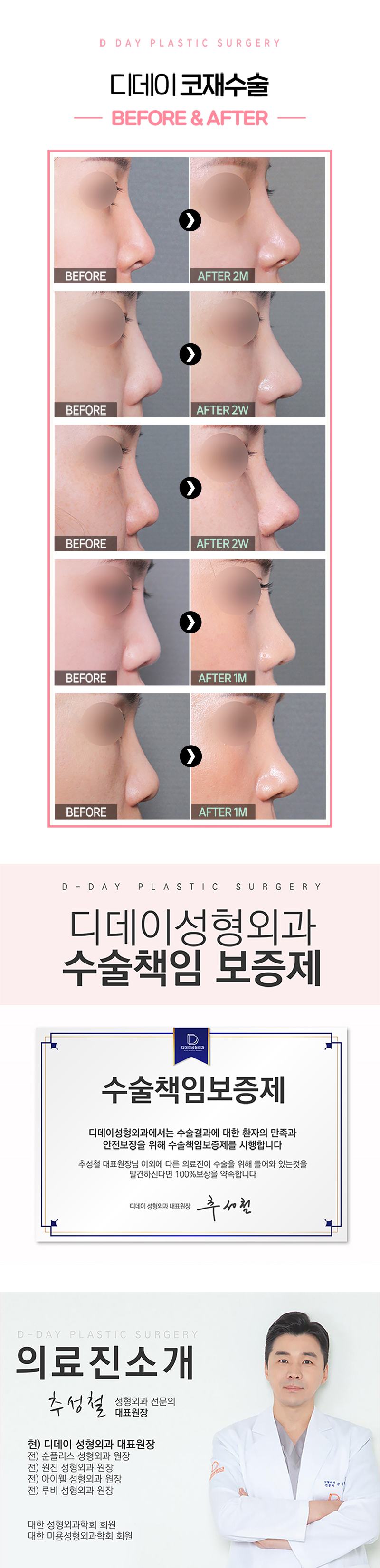 디데이성형외과의원 💖디데이 코재수술💖 이벤트, 시술 상세 이미지