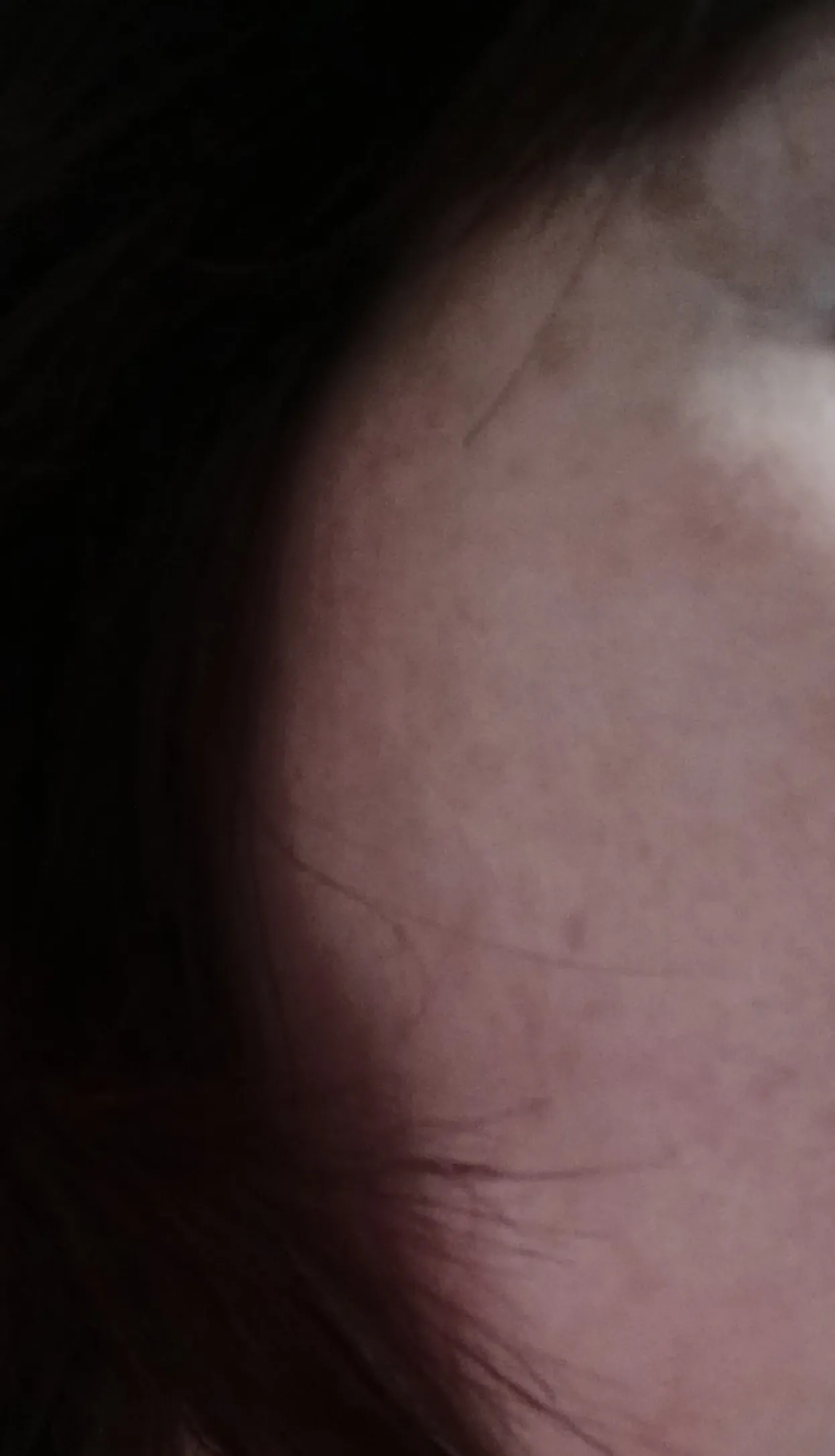 Before treatment — Pride Rejuran HB+