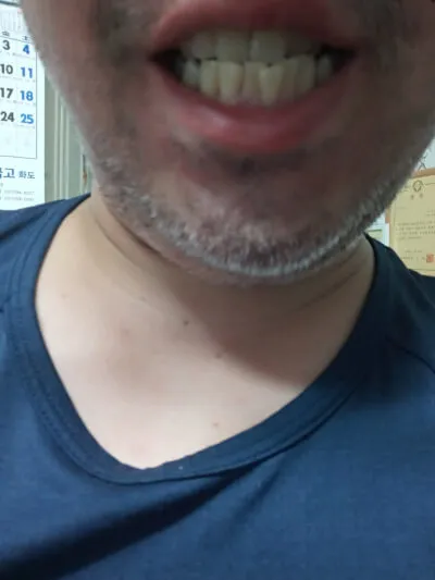 Before treatment — Teeth whitening, really! ♥ 39,000 won ♥