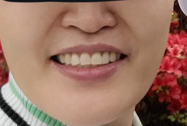 시술 전 사진