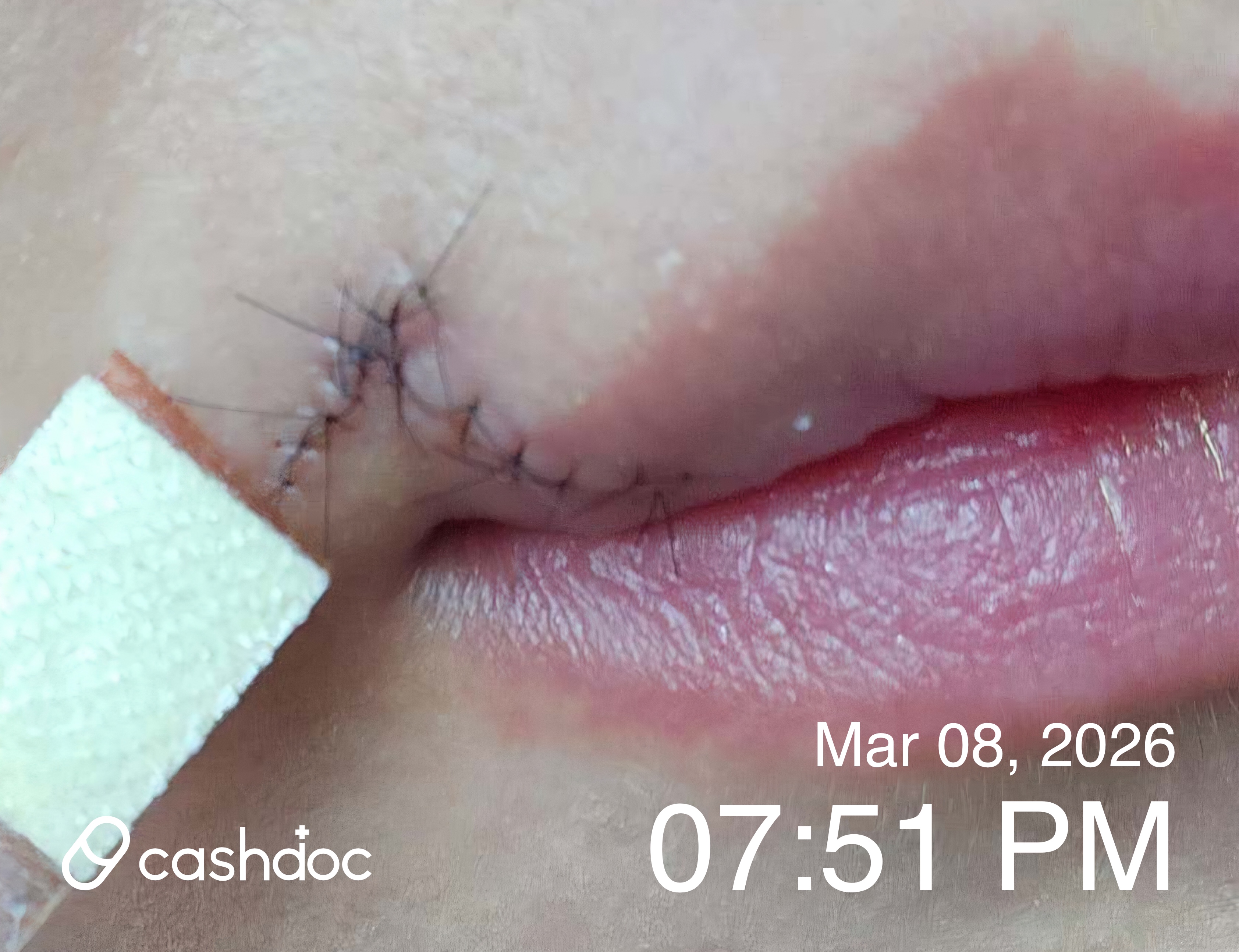 강남구 시너지성형외과의원에서 입술 흉터, 성공적 치료 후기!