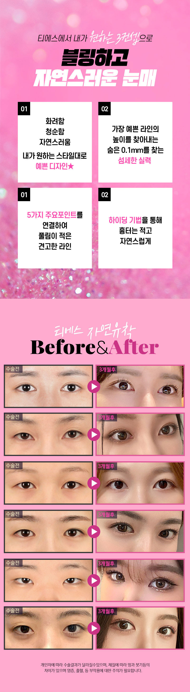티에스성형외과 티에스 첫눈 3컨셉 자연유착 이벤트, 시술 상세 이미지