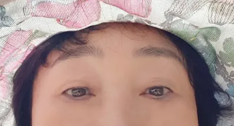 시술 전 — 눈매교정 