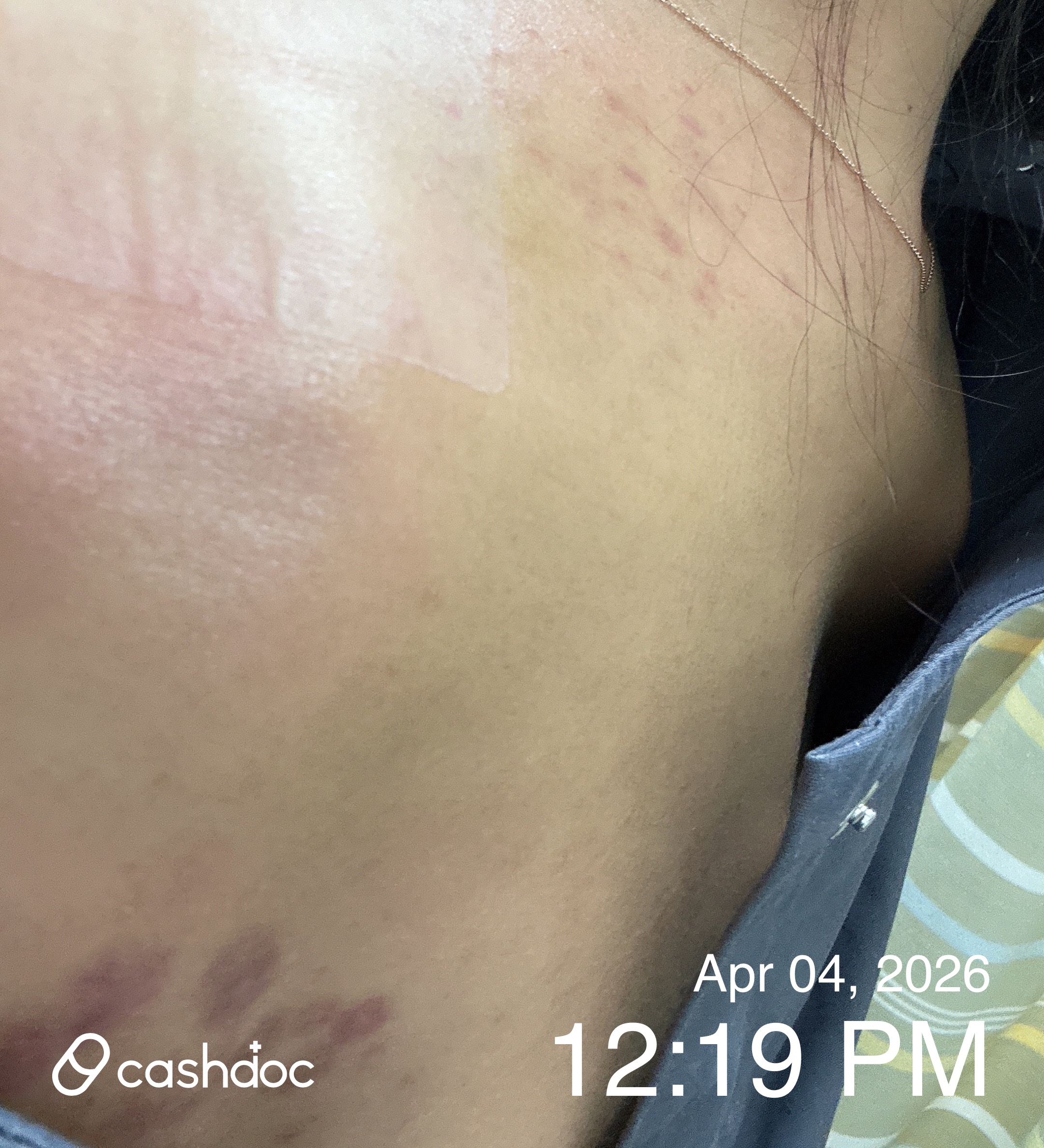 오산시 다선한의원에서 받은 시원한 침 치료 경험