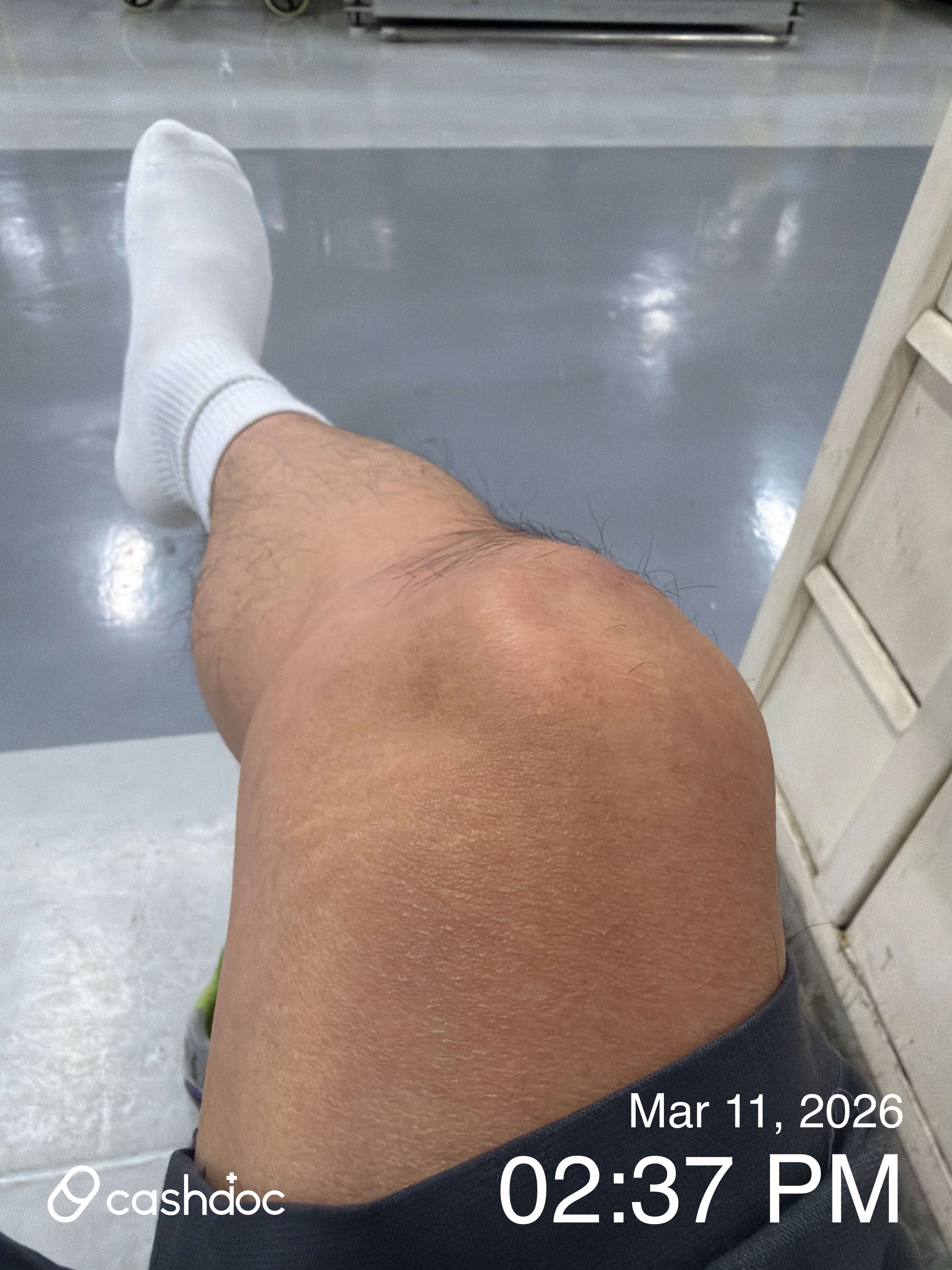 서산시 이로운한의원에서 무릅 통증 치료 후기