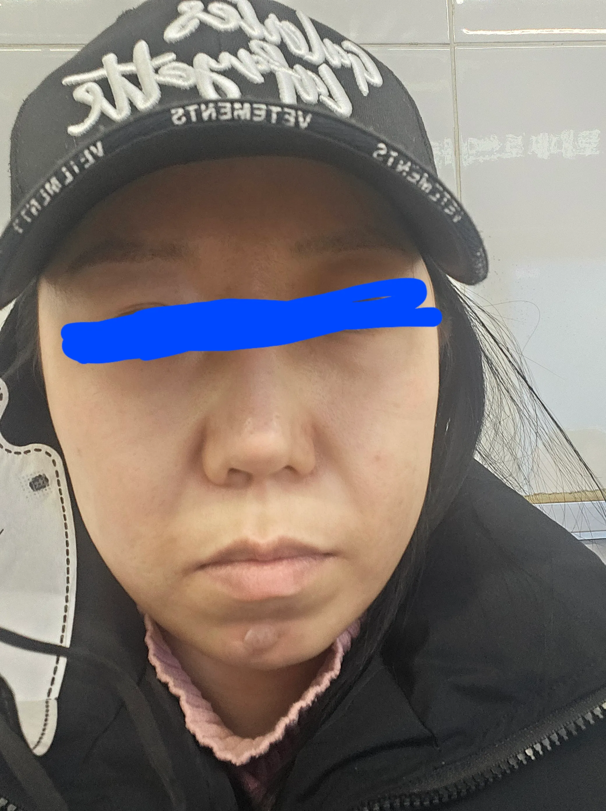 시술 전 — 팔자필러 1cc 3.8만원