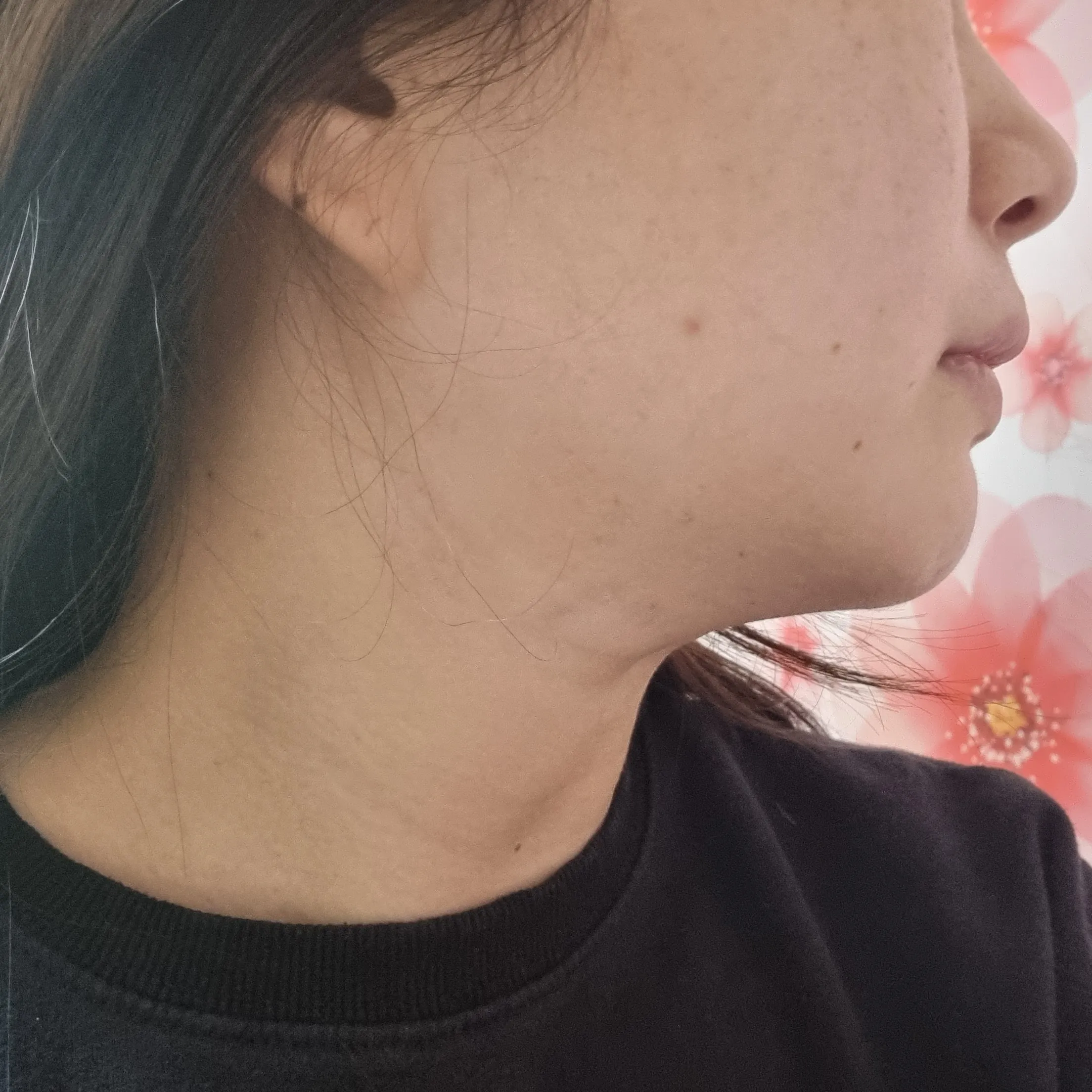 시술 전 — ★밴딩주사★ 이중턱제거