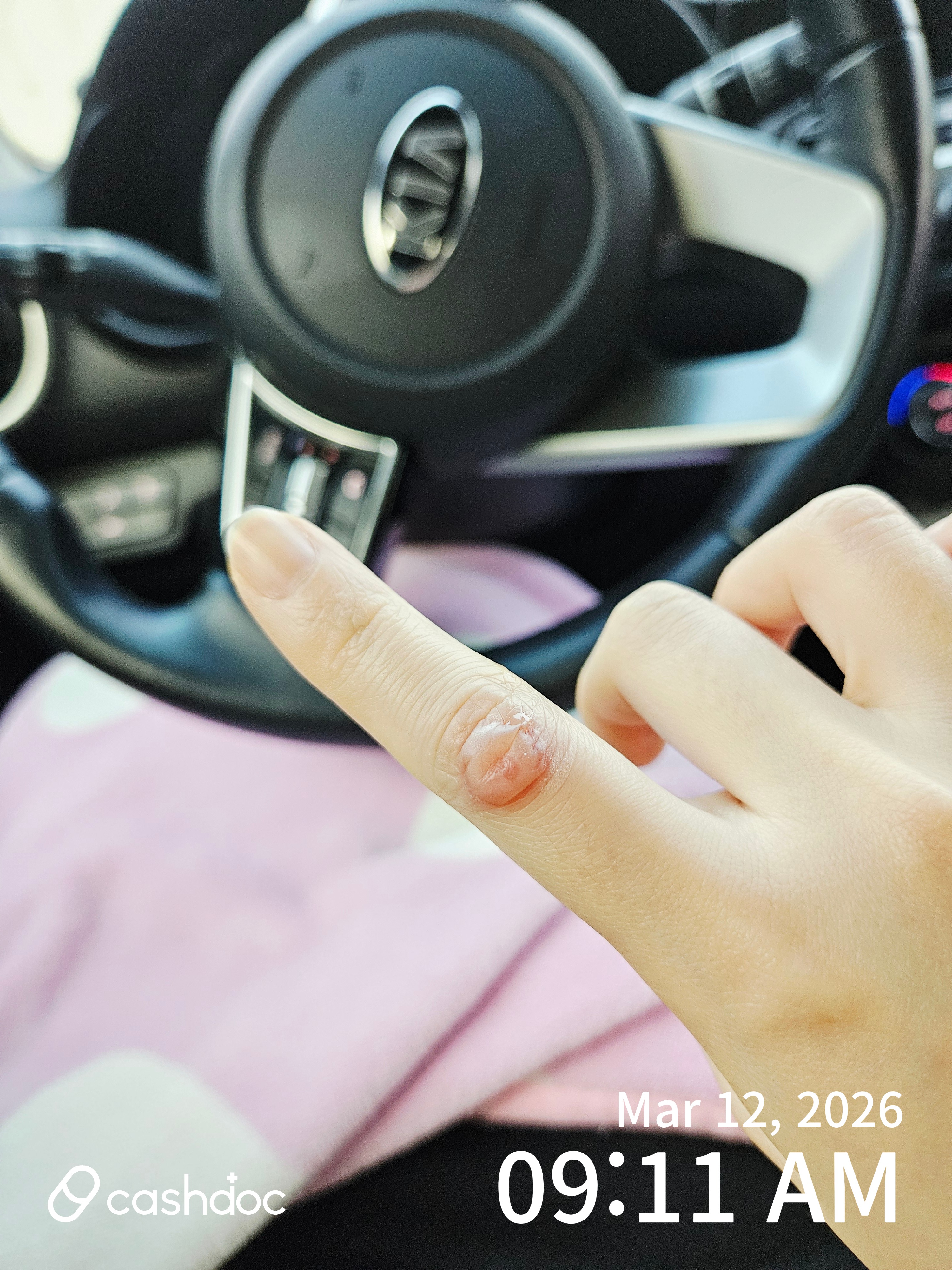 금천구 가산시그니처정형외과에서 냉동치료 추천받아 만족해요