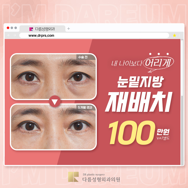 어두운 눈밑은? 다름 눈밑지방재배치 이벤트 썸네일 이미지