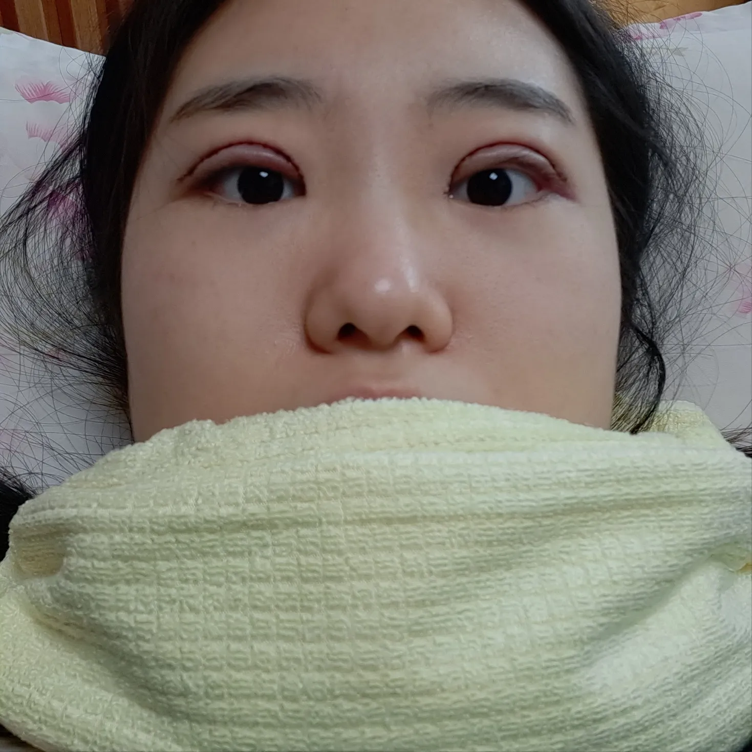 施術後 — 👁‍🗨目頭切開修復👶