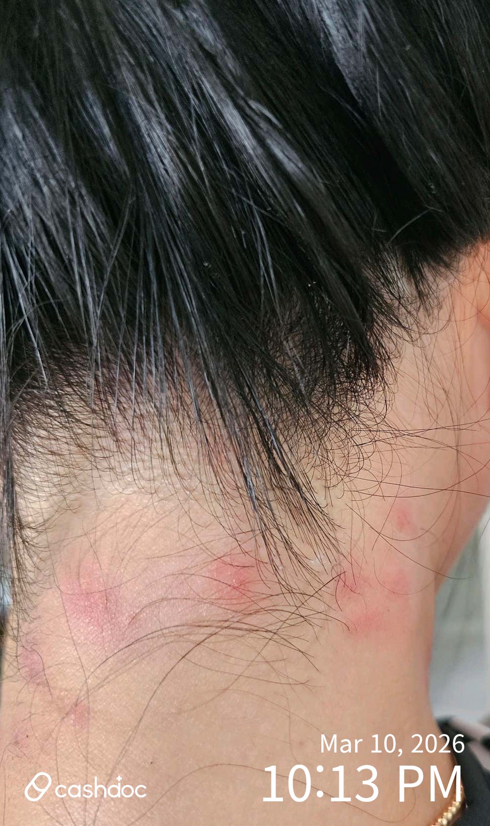 김해시 문지윤내과의원에서 급한 두드러기 치료 후기