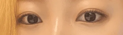 시술 후 — 눈성형~ 또렷하게 예쁜눈 