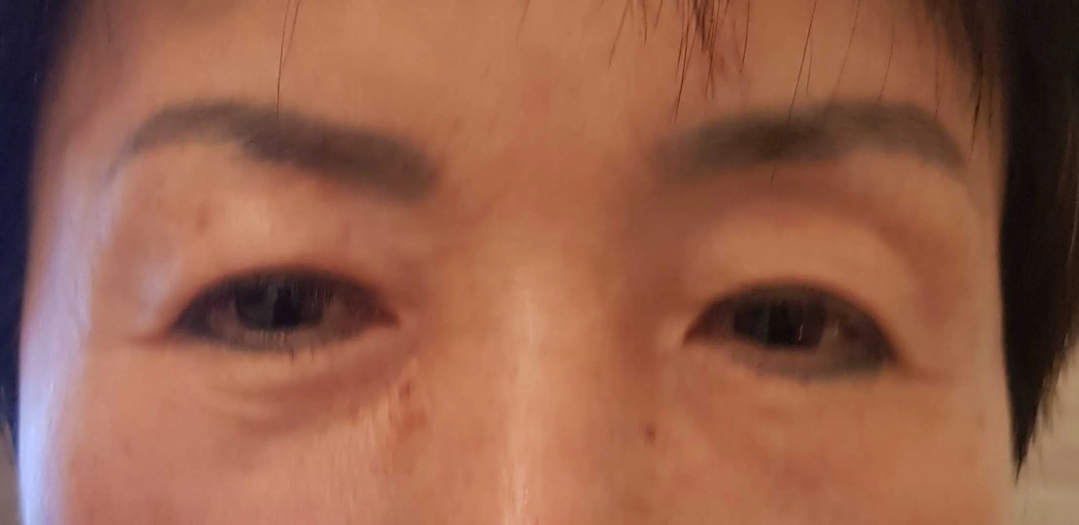 시술 전 — 눈성형~ 또렷하게 예쁜눈 