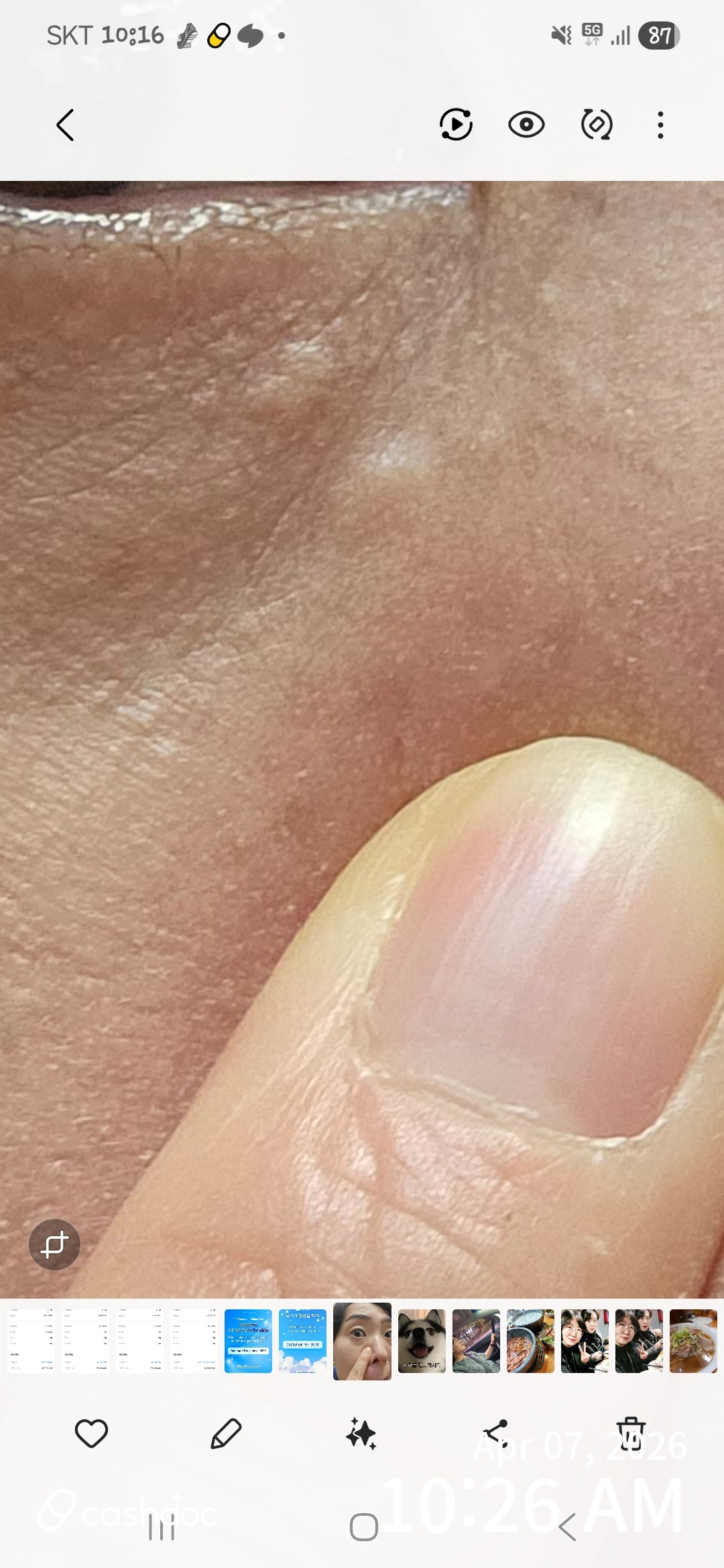 성남시 메이퓨어 수내점에서 안전하게 비립종 제거 경험