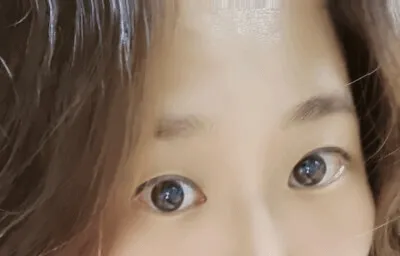 시술 전 — ◆ 확트이는 절개쌍꺼풀 ◆