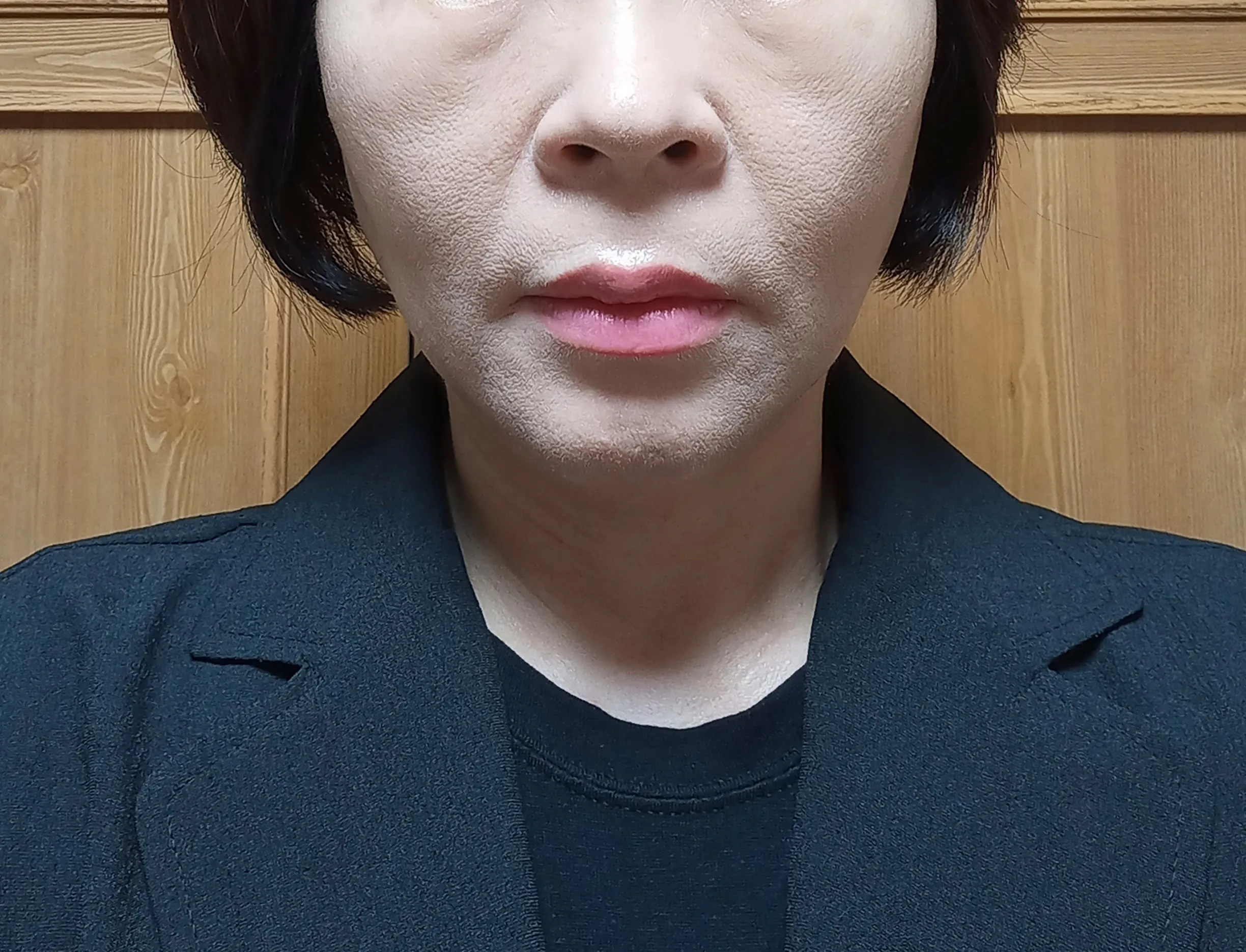 시술 전 — 팔자필러 1cc 3.8만원