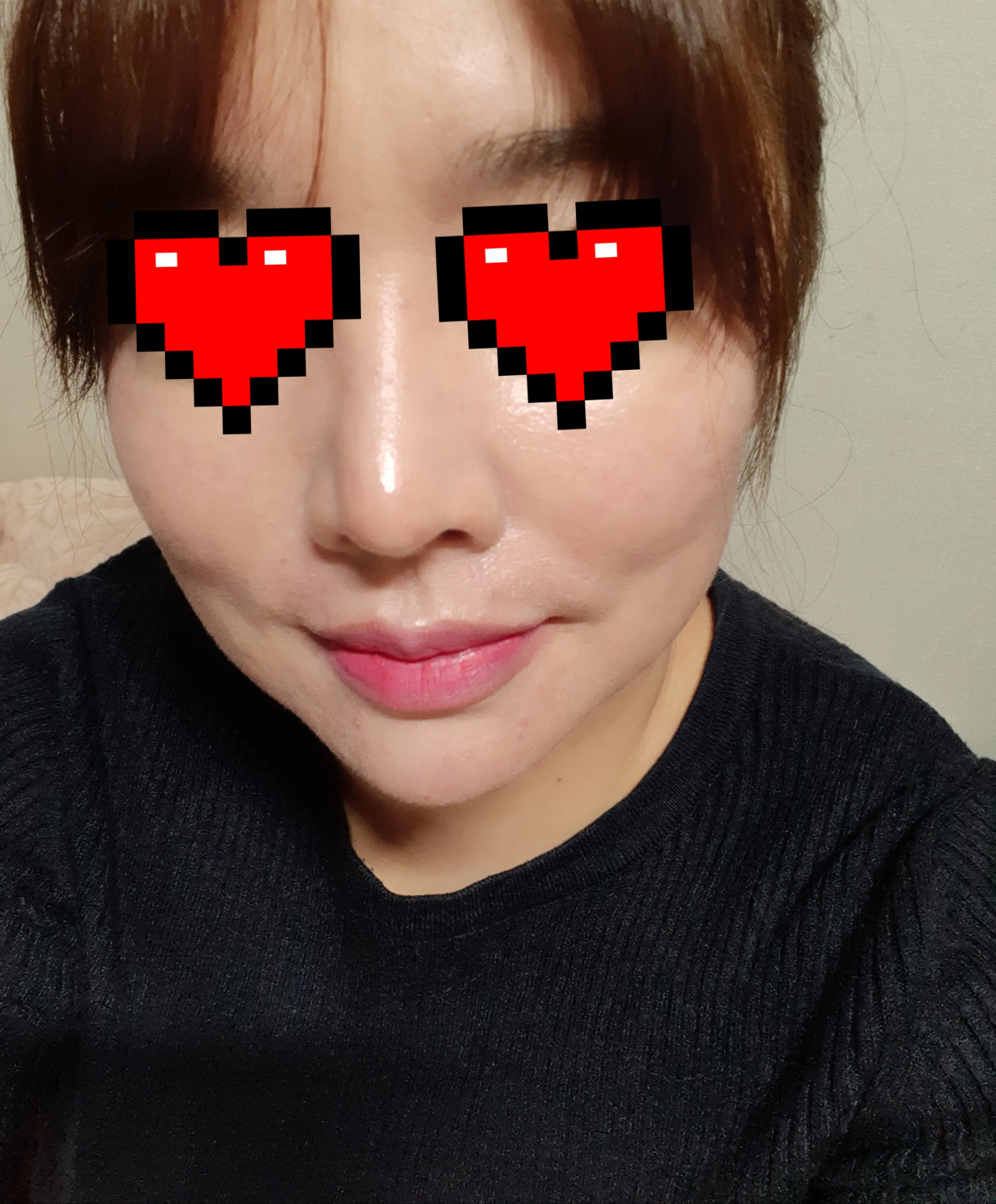 시술 후 — 명품스킨부스터 #NCTF주사 