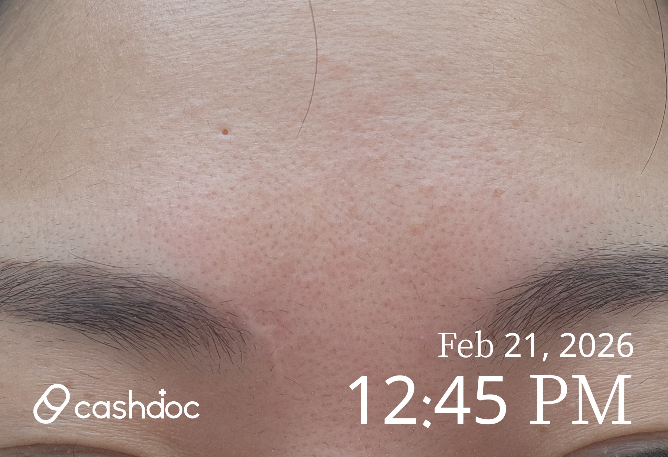 천안시 메이퓨어의원에서 받은 미간 보톡스, 빠르고 편안해요