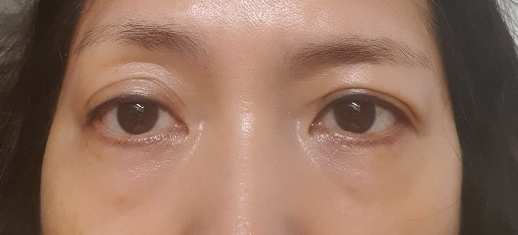 施術前 — トップフェイス➰中年目整形 #上まぶた #下まぶた