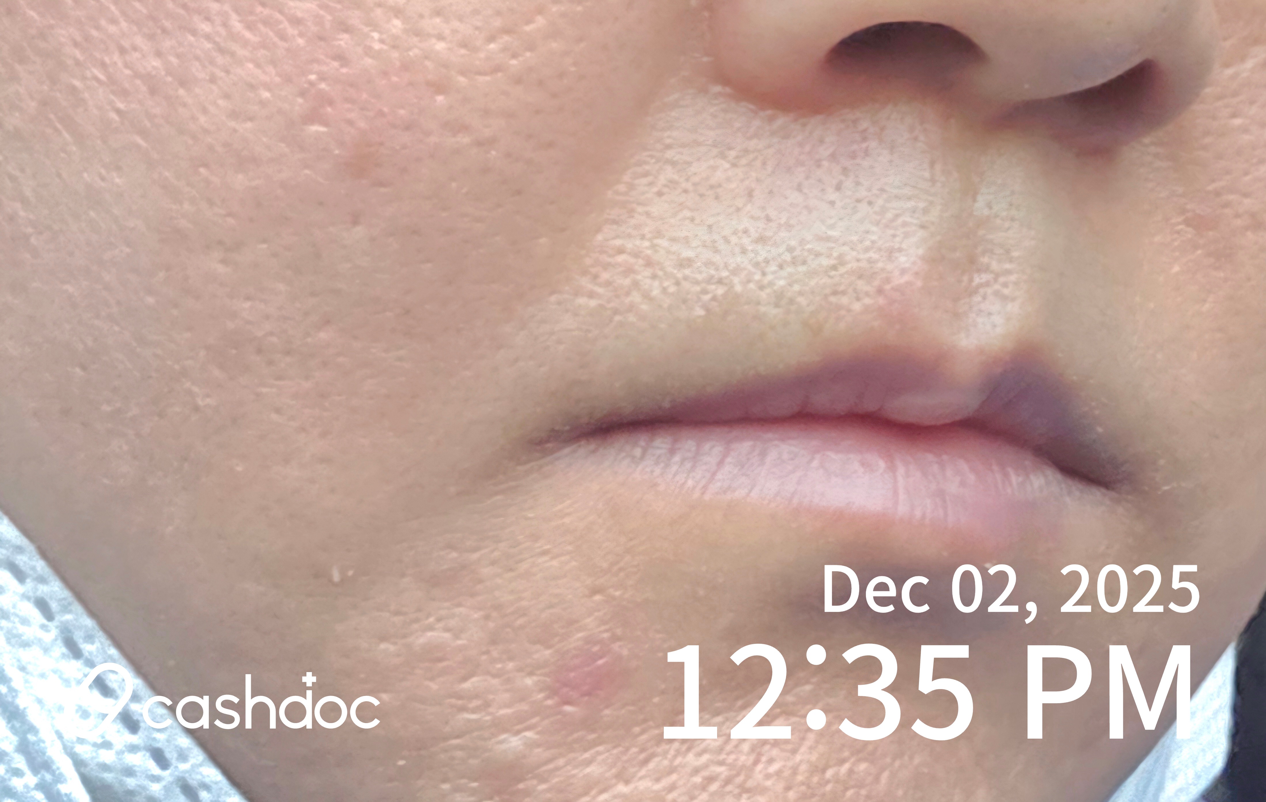 서울에서 인모드FX와 카프리 레이저 체험 후기 - 친절하고 꼼꼼해요!