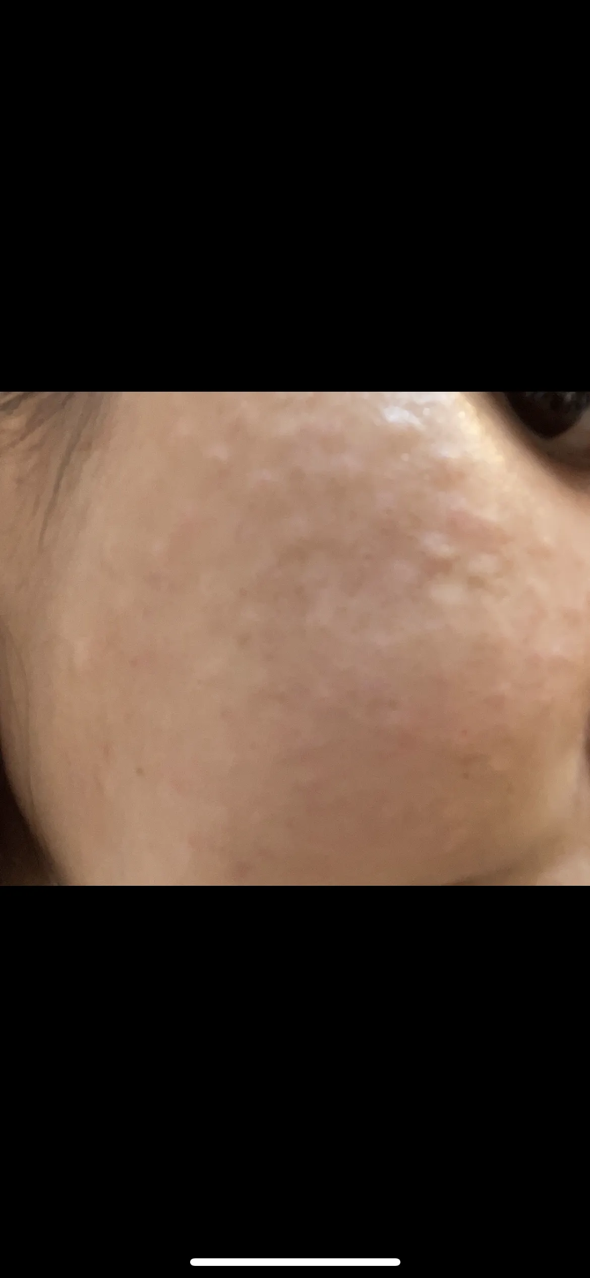 Before treatment — ★ Rejuran Healer 7.9 ★ Pore Reduction, Skin