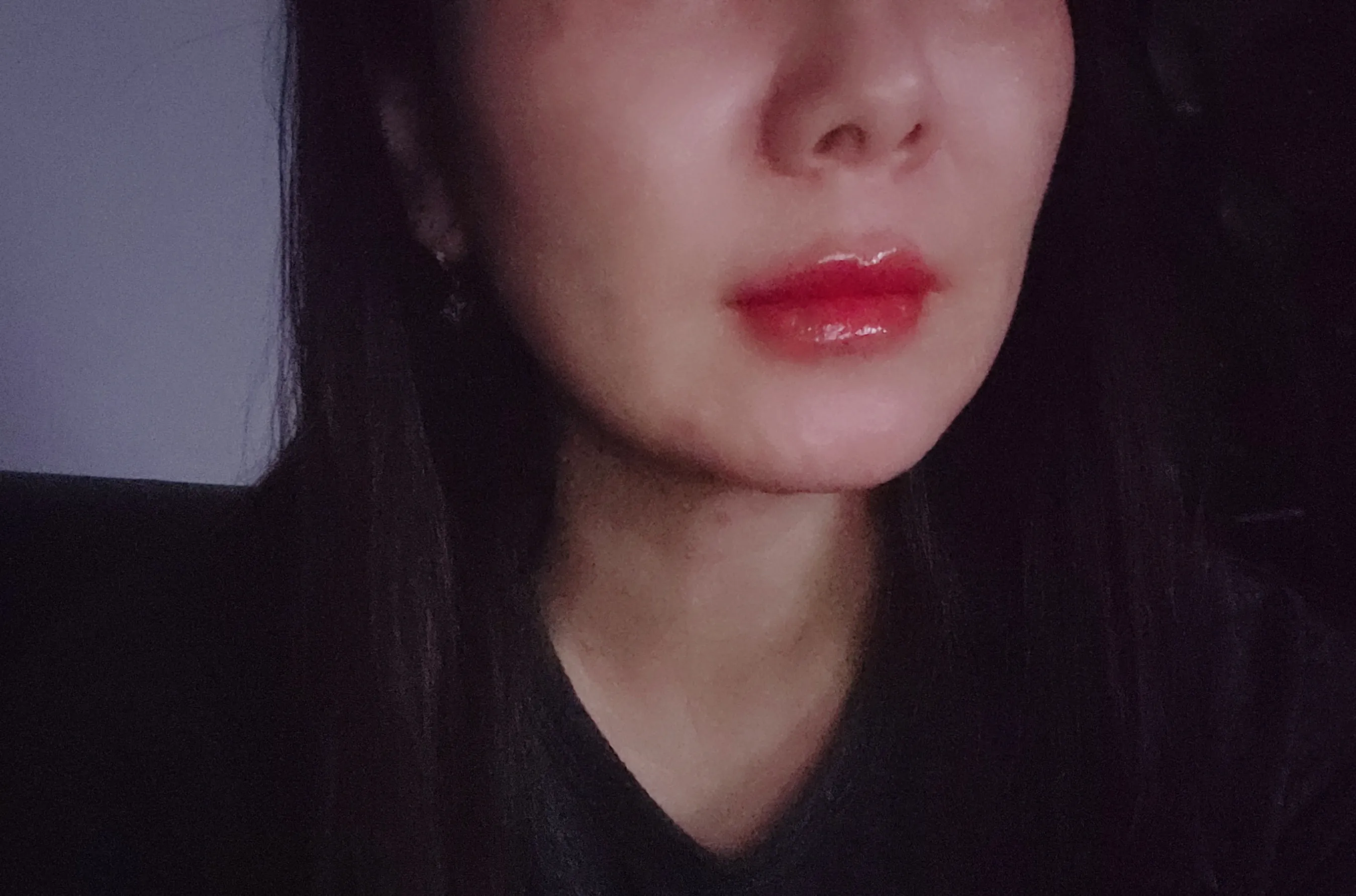 시술 후 — 미케이 피부 탄력개선_슈링크 300샷