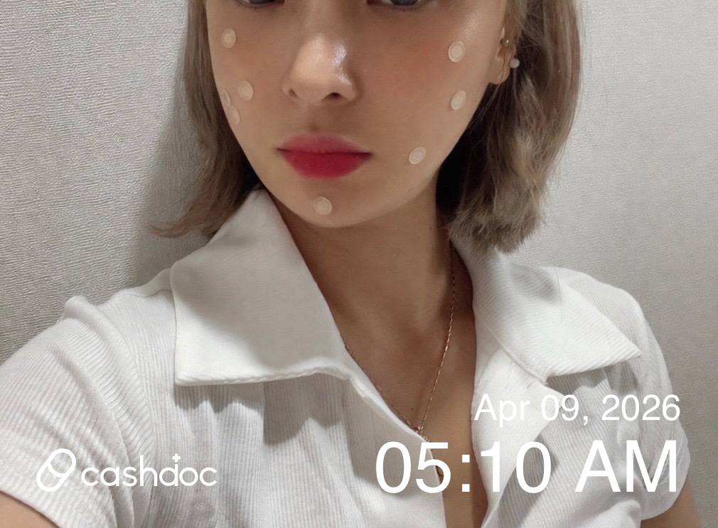 아름다운피부과의원에서 번거로웠던 점 제거 시술 후기