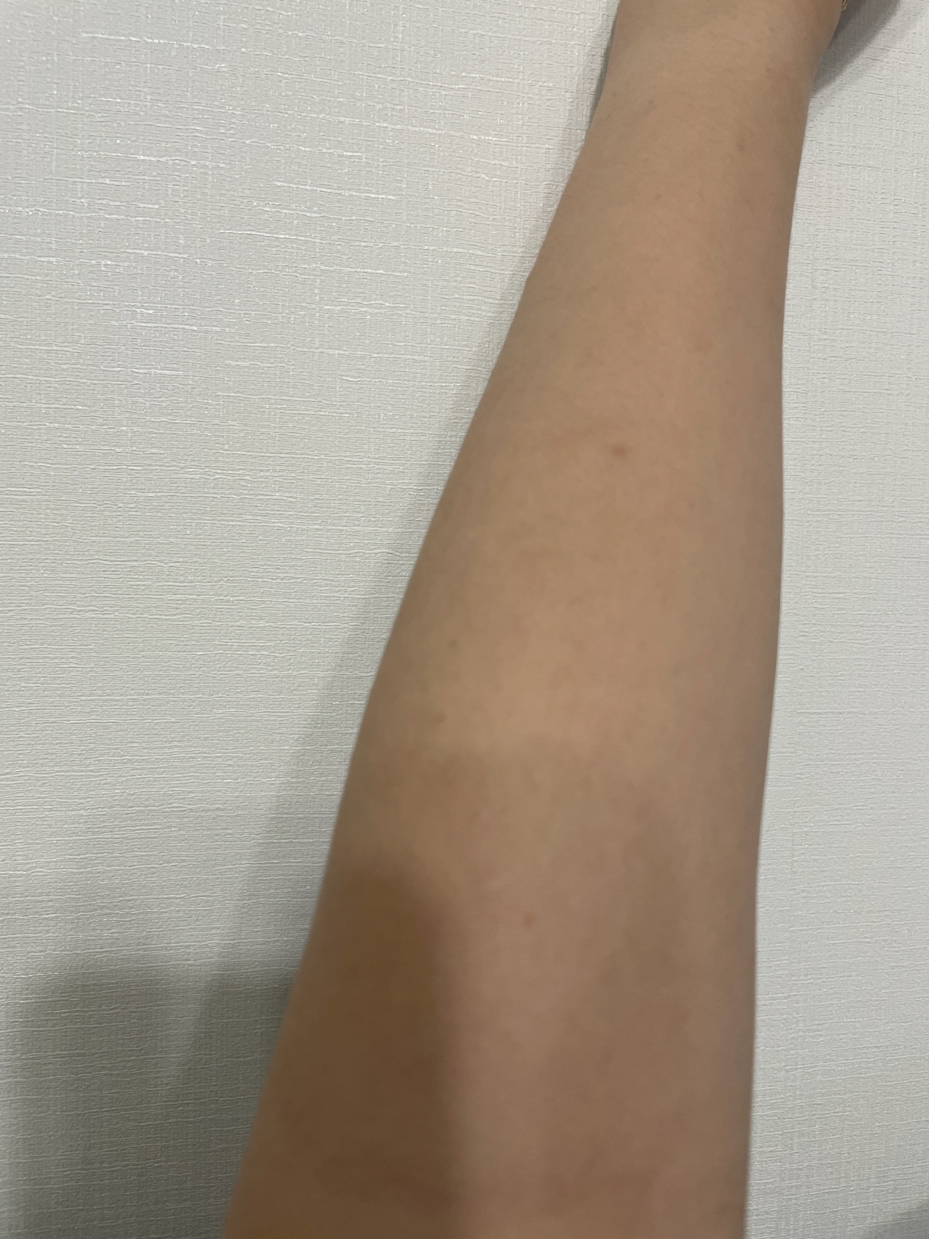 施術後 — クラリティアイスレーザー脱毛