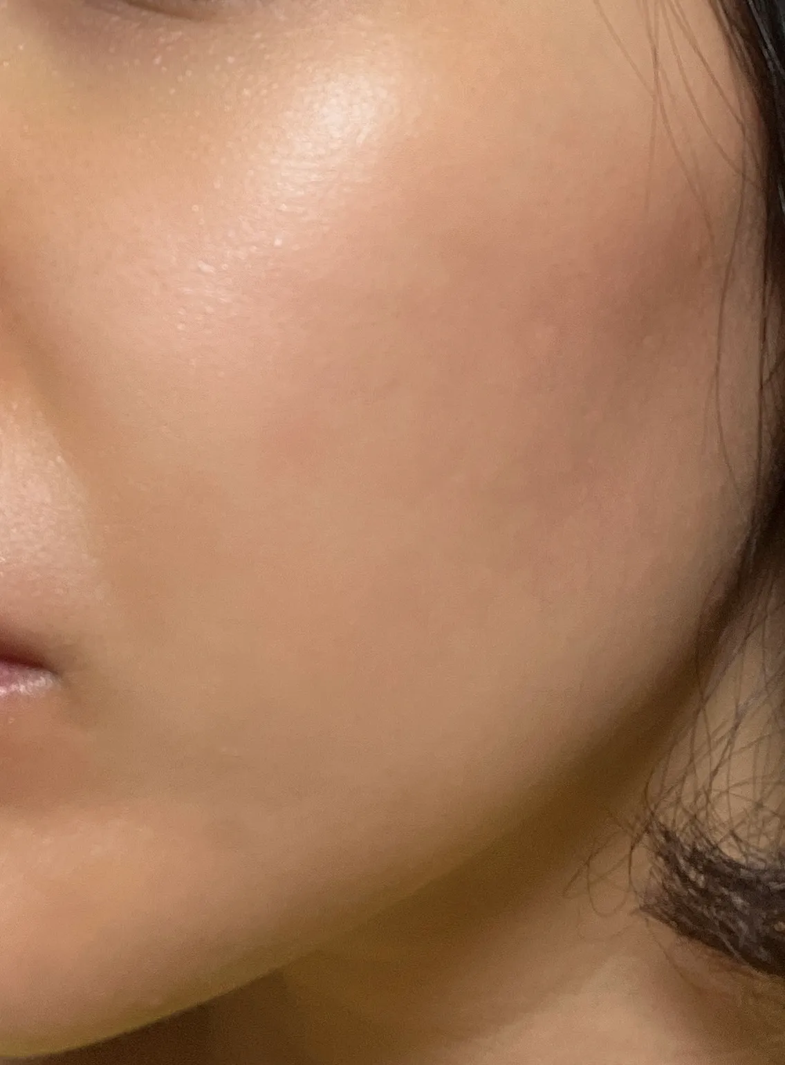 After treatment — Rejuran, Elasticity and Regeneration in One