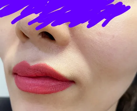 시술 전 — 눈밑꺼짐 팔자주름 울트라콜