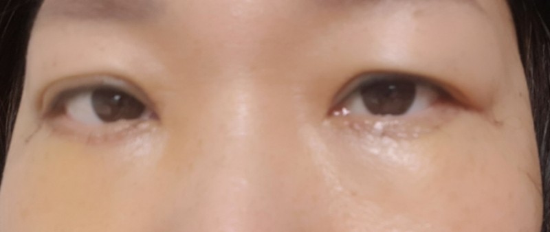 项目后 — 下垂眼袋皱纹! 下睑整形 700,000元