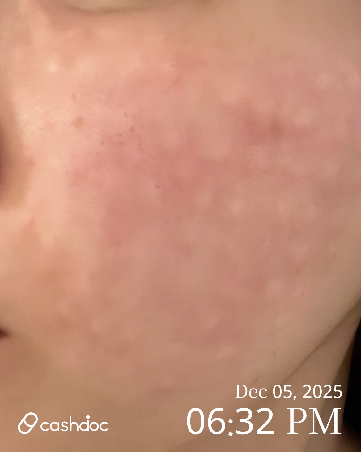 타임리스피부과 도곡점에서 리쥬란 힐러 후기