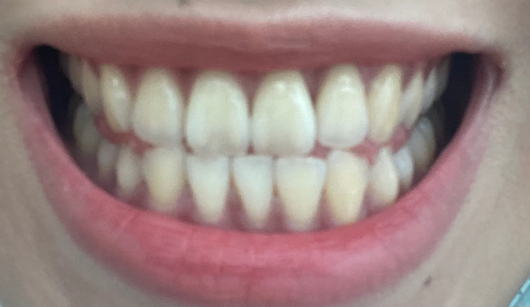 After treatment — Teeth whitening, really! ♥ 39,000 won ♥