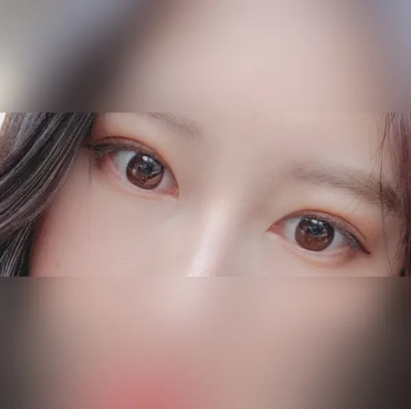 시술 후 — 눈매교정 