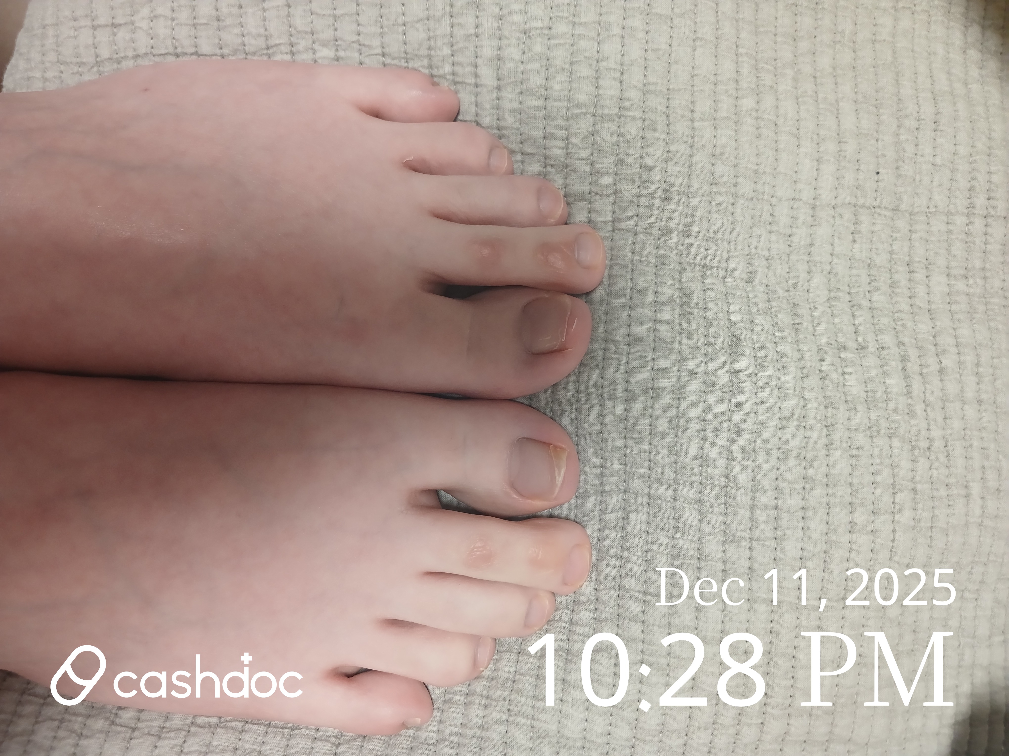 박피부과의원에서 놀란 발가락 동상 경험