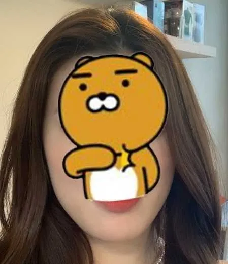 Before treatment — Wonjin_Facial Contouring