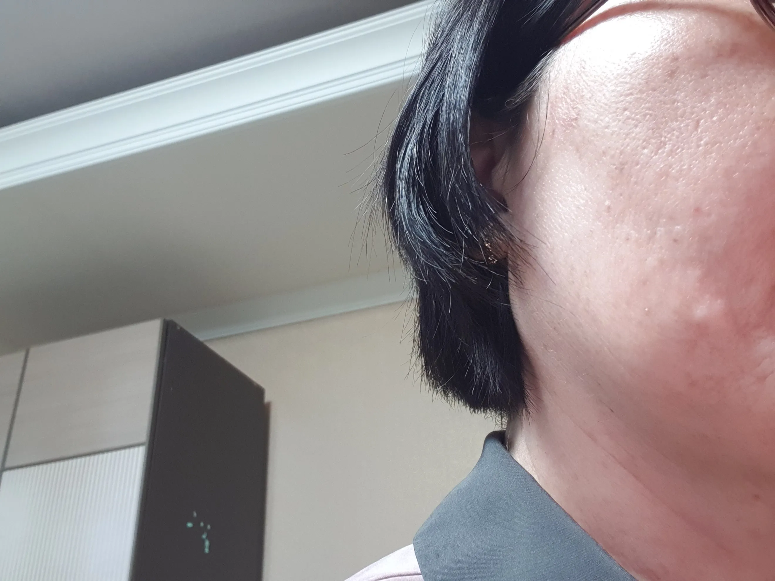 시술 후 — 미케이 피부색소 지우개