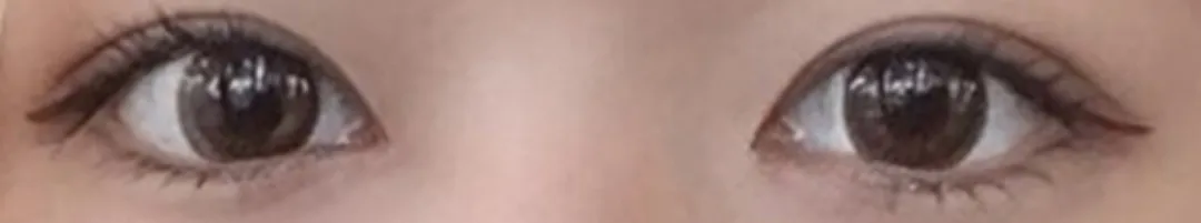 시술 후 — 눈매교정 