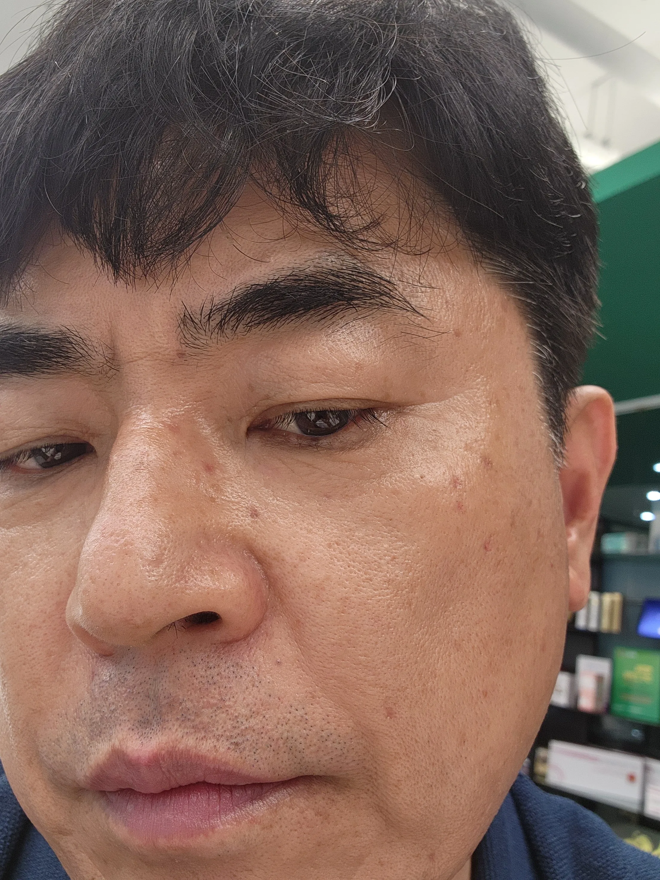 시술 후 — 얼굴 점제거