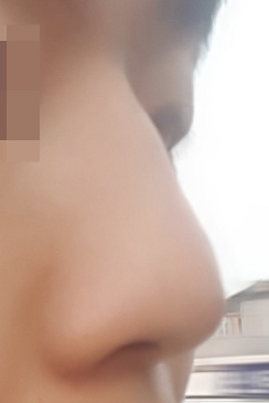 施術前 — 男性のための機能的鼻形成