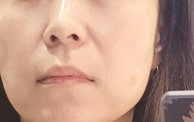 시술 후 — 1회시술 3년유지💜콜라겐 실리프팅