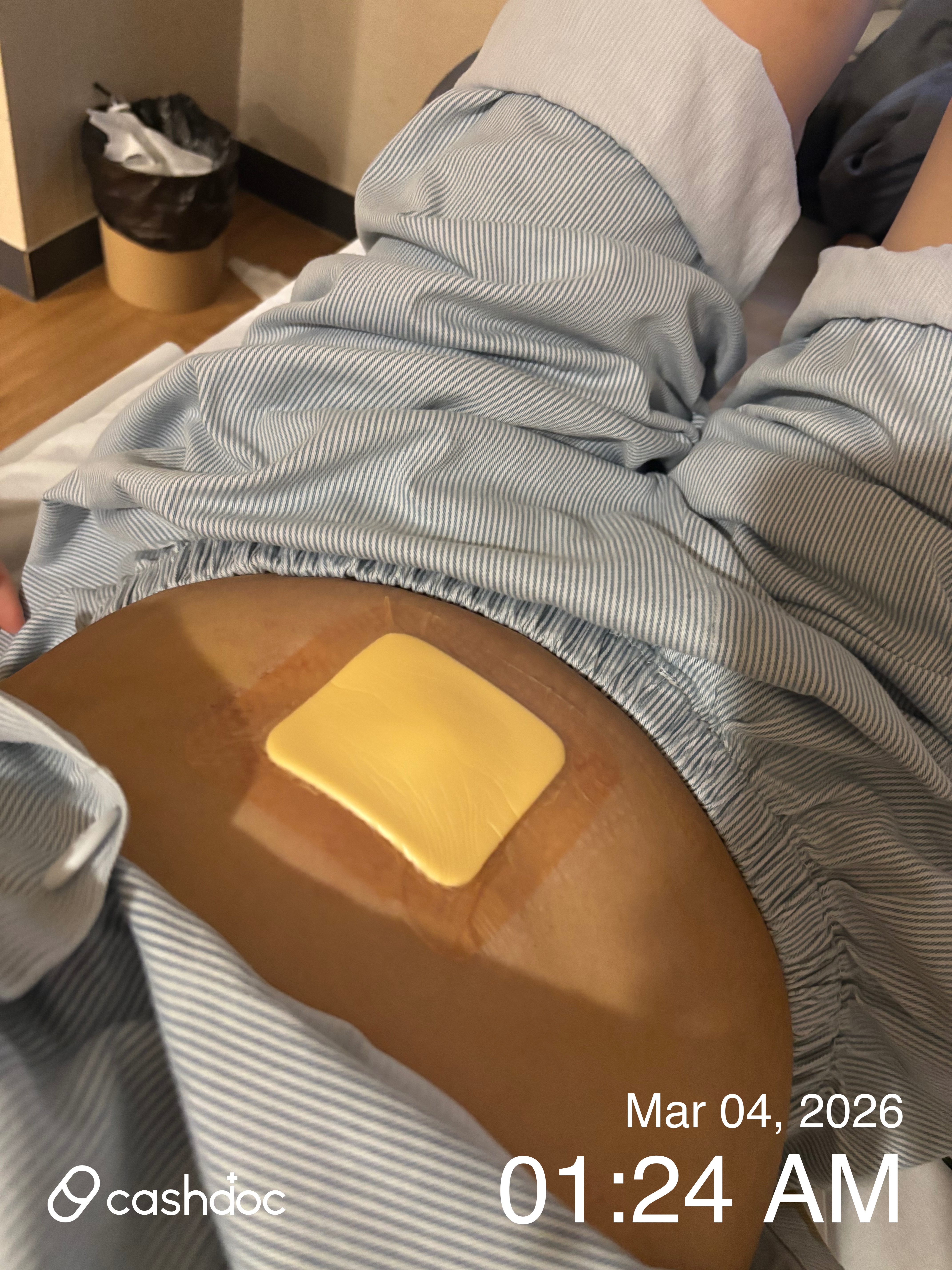 북구 의료법인기쁨의료재단엠디한방병원에서의 담석증 단일공 복강경 수술 후기