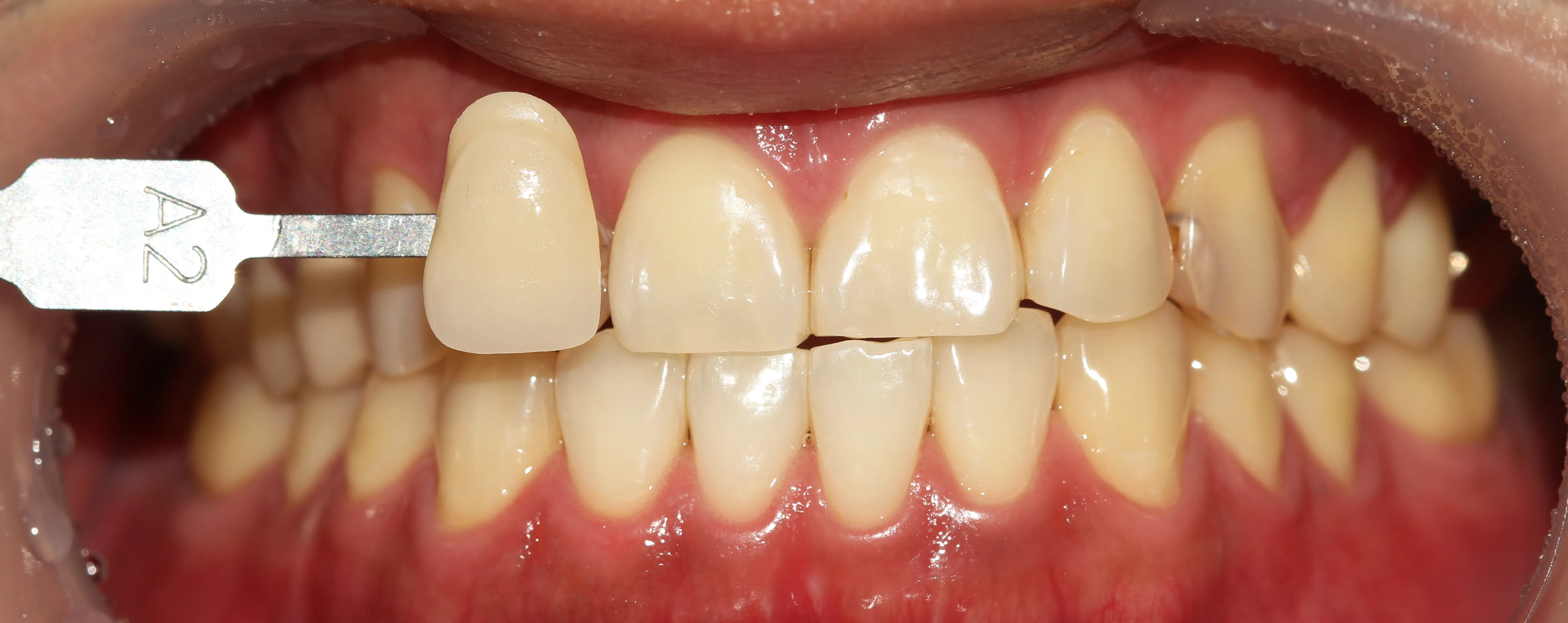After treatment — Teeth whitening, really! ♥ 39,000 won ♥