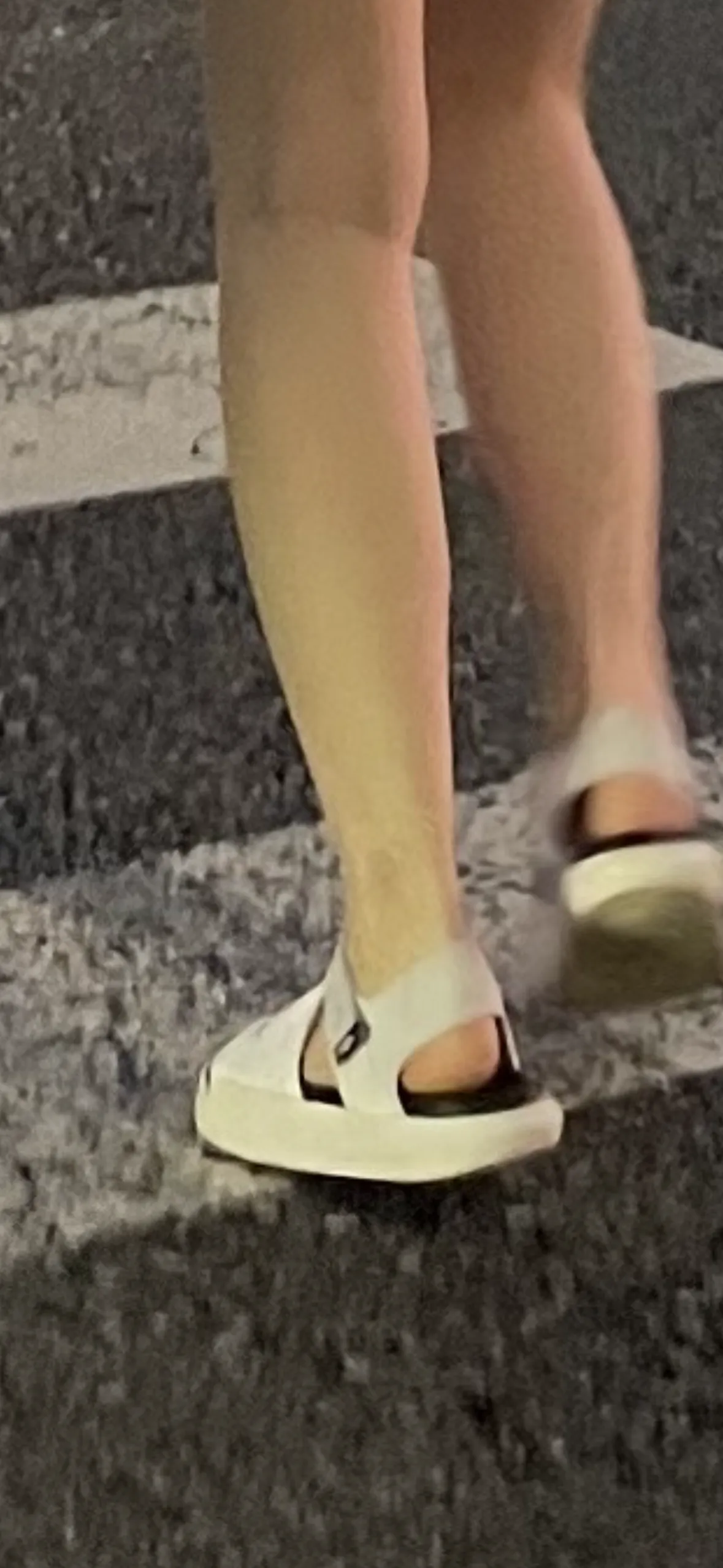 시술 후 — 바디보톡스/다한증 보톡스