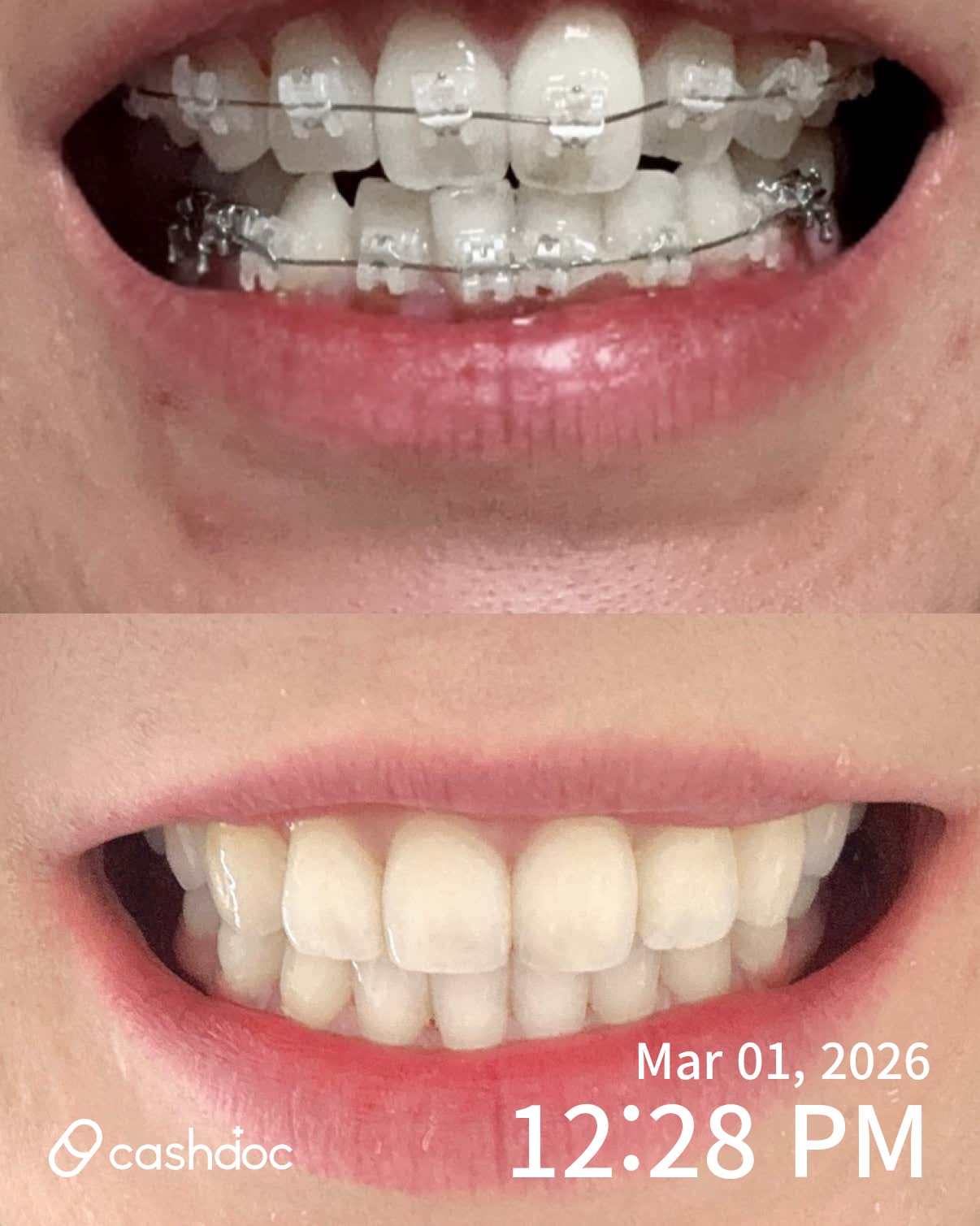 관악구 이수백치과의원에서 교정도 임플란트도 대만족!