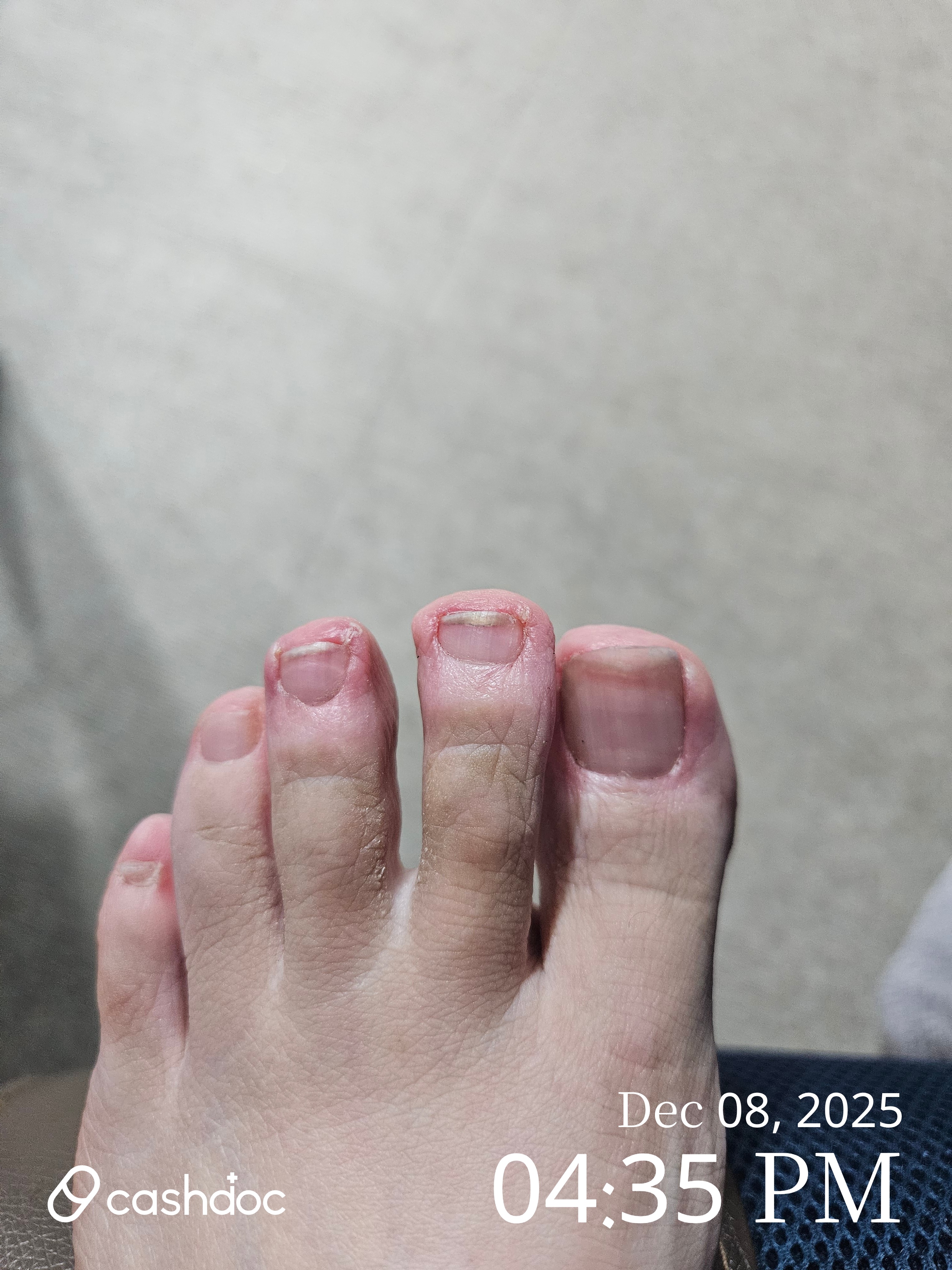 기장군 본피부과에서 발톱무좀 염증 치료 경험, 레이저는 필요 없었어요