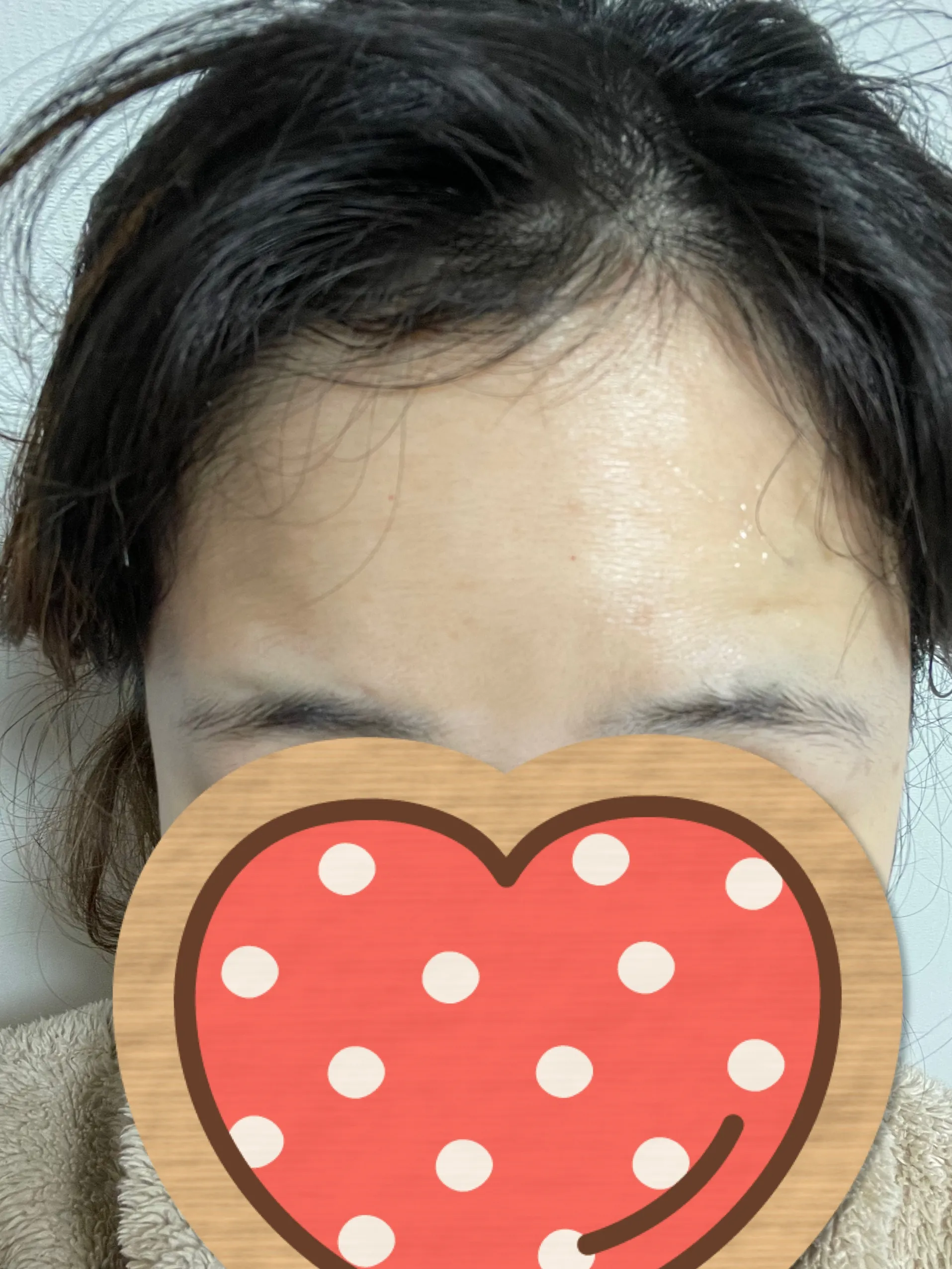 시술 후 — [앵콜]강남점_주름 보톡스 4900원