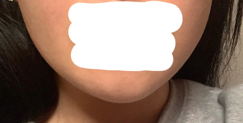After treatment — Wonjin_Facial Contouring